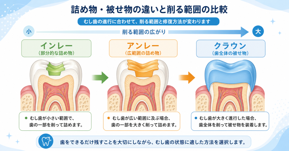 ■インレー・アンレー・クラウンとは？歯の詰め物・被せ物の基本を解説