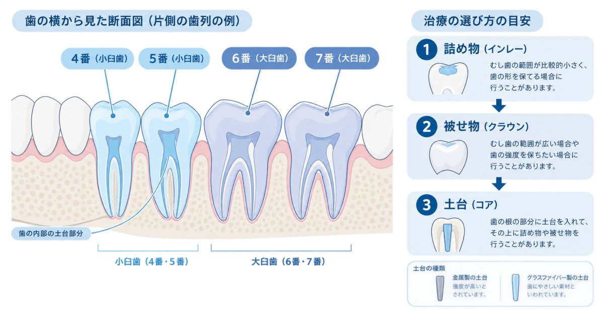 銀歯が保険適用のCAD/CAM冠・インレーに交換できる条件